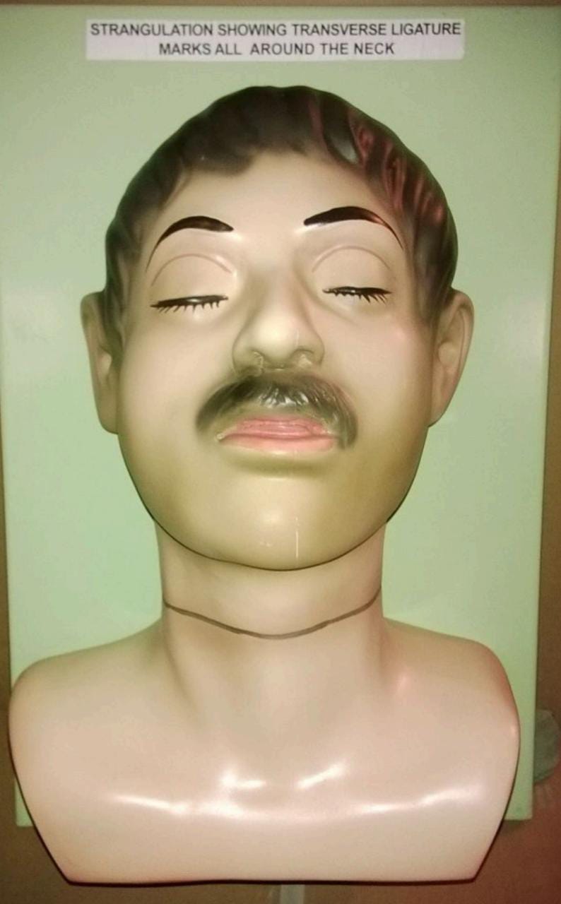 Buy Strangulation Showing Transverse Ligature Marks All Around The Neck