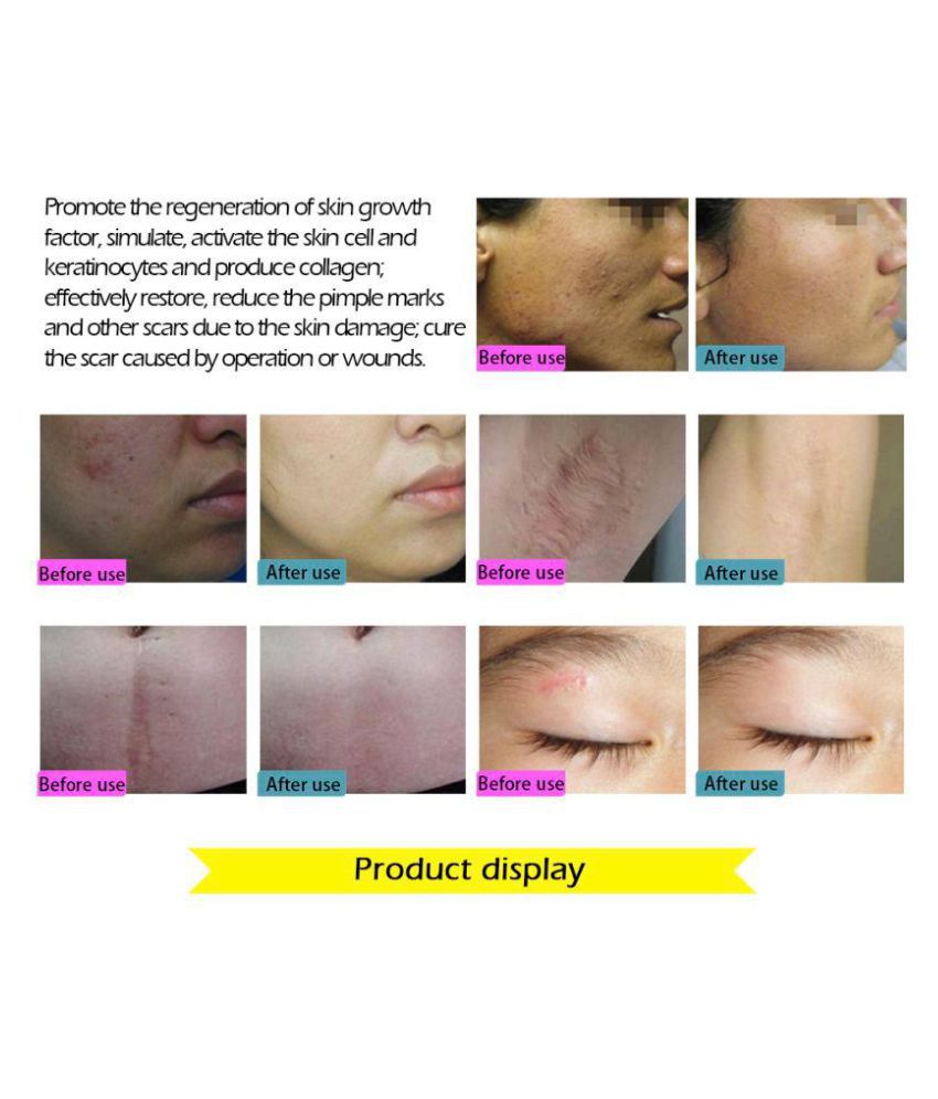 lanbena stretch mark removal