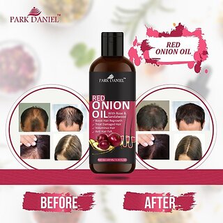                       PARK DANIEL 100% Pure & Natural RED ONION OIL- For Hair Regrowth & Anti Hair fall Hair Oil (100 ml)                                              
