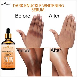                       PARK DANIEL Whitening Serum For Remove Dark Knuckles Elbow & Knee Pack of 3 (30 ml) Men & Women (90 ml)                                              